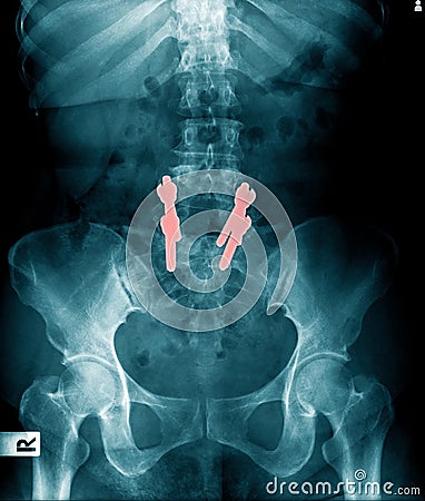 X-ray image l-spine fixation Stock Photo