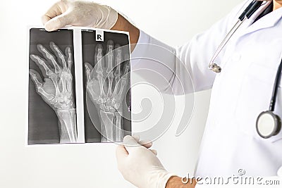 X-Ray image of human hands,Doctor examining a lung radiography, Doctor looking chest x-ray film,Anatomy. Stock Photo