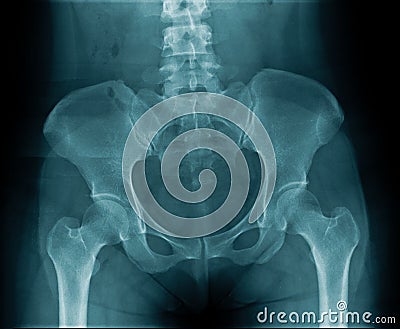 X-ray image lumbar spine and degenerative change of spine Stock Photo