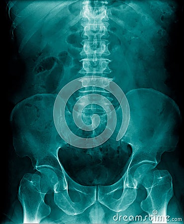 X-ray image lumbar spine Stock Photo