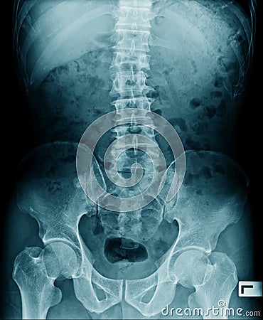 X-ray image lumbar Stock Photo