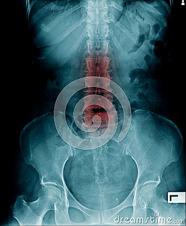 X-ray image lumbar Stock Photo