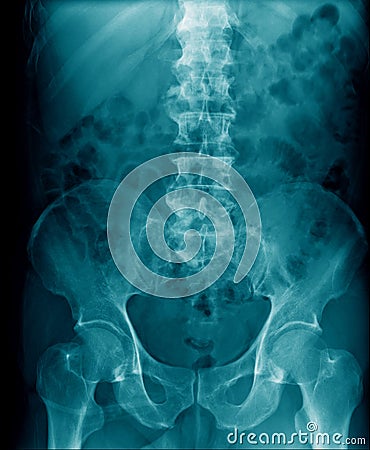 X-ray image lumbar Stock Photo