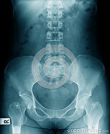 X-ray image lumbar Stock Photo