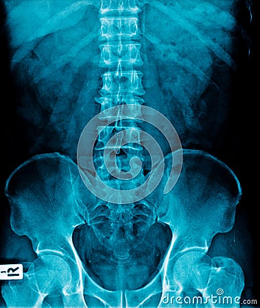 X-ray image lumbar Stock Photo