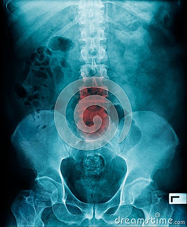 X-ray image lumbar Stock Photo