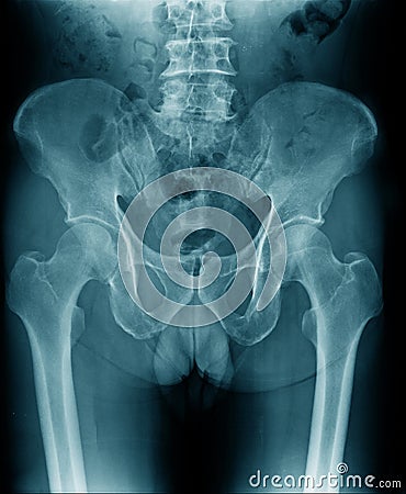 X-ray image lumbar Stock Photo