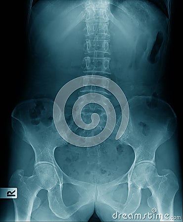 X-ray image lumbar Stock Photo