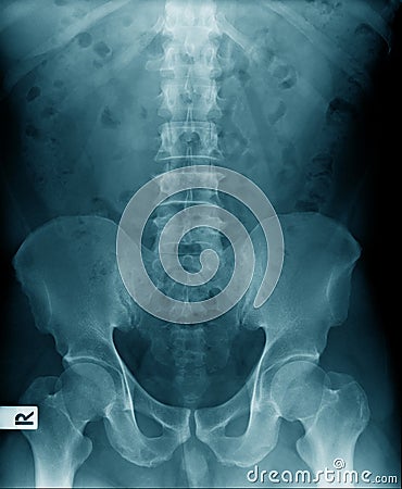 X-ray image lumbar Stock Photo