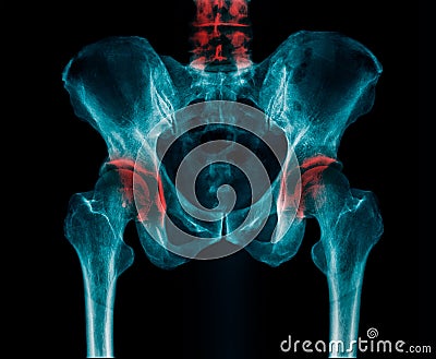 X-ray image lumbar Stock Photo