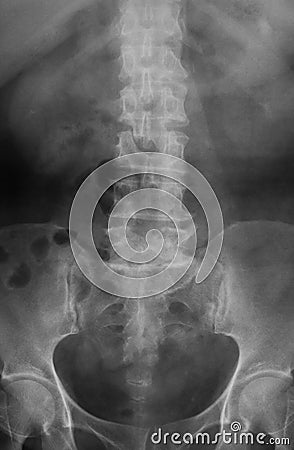 .X-ray image of Lumbosacral (L-S) spine. Stock Photo