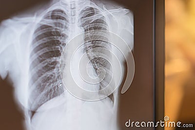 X-ray image of patient lungs to lung tumor, Lung Cancer or Pneumonia Stock Photo