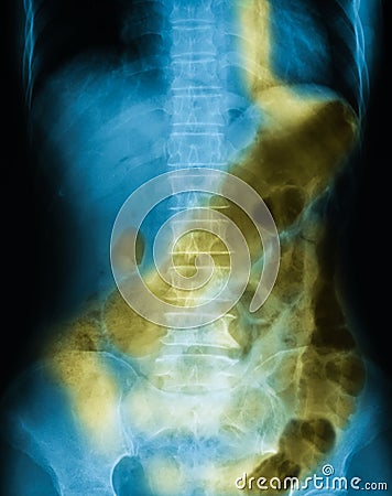 X-ray image of plain abdomen supine. Stock Photo