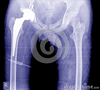 Total Hip Arthroplasty good quality show post operation at hip. Stock Photo