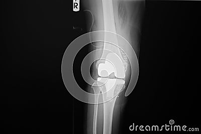 X-ray image of lanteroposteriorright knee joint with total knee replacement. Stock Photo