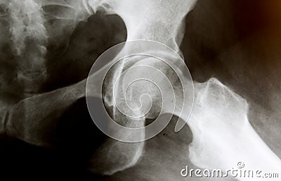 X-Ray image of regular hip joint Stock Photo