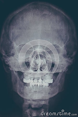 X-ray image or roentgen of human skull, close-up. Head xray scan of skeleton head. Abstract medical concept Stock Photo