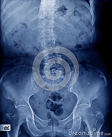 X-ray image scoliosis and spondylosis human spine Stock Photo