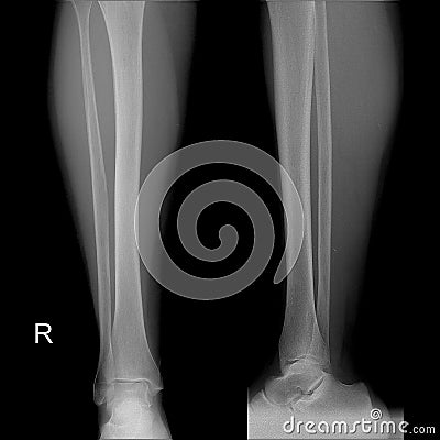 X-ray image of shin , Frontal Sagital view normal. Stock Photo