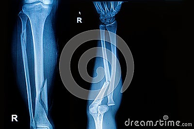 X-ray image show fracture leg and forearm Stock Photo