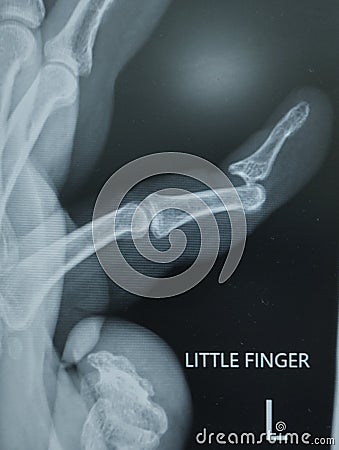 X-ray image shows dislocation of the proximal joint of Left little finger. Stock Photo