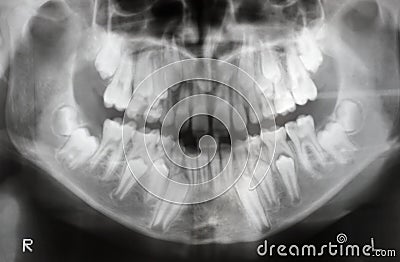 X-ray of jaw with teeth and mi Stock Photo