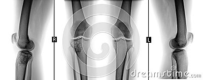 X-ray of knee joints. Giant cell tumor of the right tibial. Negative. Stock Photo
