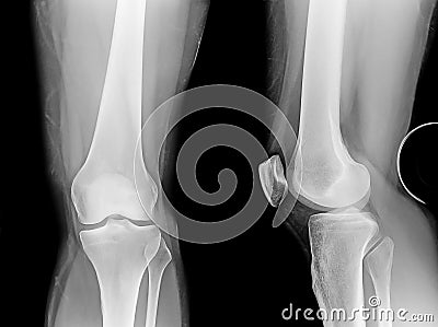 X-ray of the knee, lateral and posterior views. Stock Photo