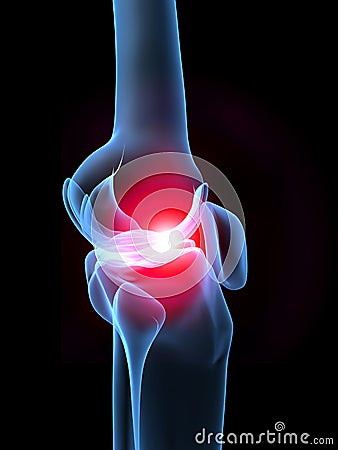 X-ray knee with pain Cartoon Illustration