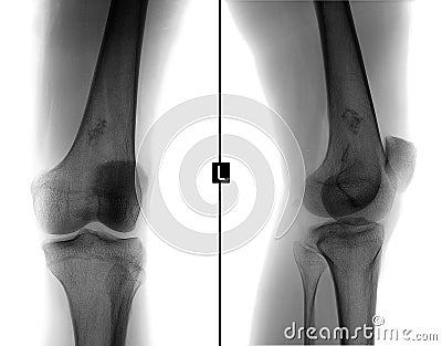 X-ray of the left knee joint. Ewing sarcoma, lymphoma, myeloma thigh bone. Negative. Stock Photo