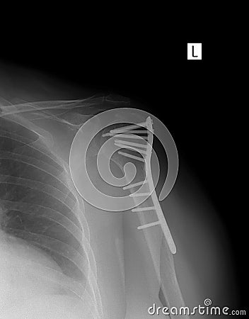 X-ray of the left shoulder. Fracture of the shoulder with metal. Stock Photo