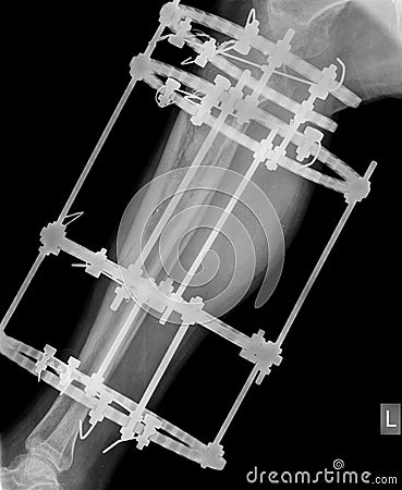 X-ray of leg with fixation Stock Photo