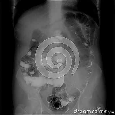 X-ray of the lower parts of the gastrointestinal tract GI. Insufflation by air. Chronic colitis. Stock Photo