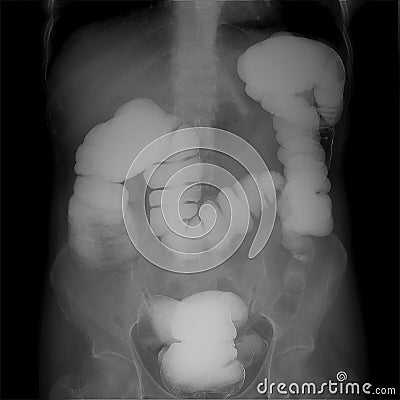 X-ray of the lower parts of the gastrointestinal tract GI. Tight filling. Chronic colitis. Stock Photo