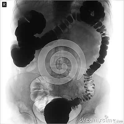 X-ray of the lower parts of the gastrointestinal tract GI. Tight filling. Dolichocolon. Diverticulosis. Negative. Stock Photo