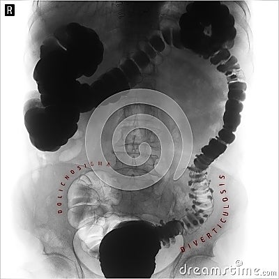 X-ray of the lower parts of the gastrointestinal tract GI. Tight filling. Dolichocolon. Diverticulosis. Negative. Marker. Stock Photo