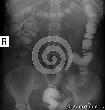 X-ray of the lower parts of the gastrointestinal tract GI. Tight filling. Dolihosigma, diverticulosis. Stock Photo