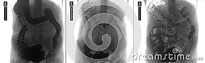 X-ray of the lower parts of the gastrointestinal tract GI. Tight filling. Emptying. Insufflation by air. Dolichocolon. Negative. Stock Photo