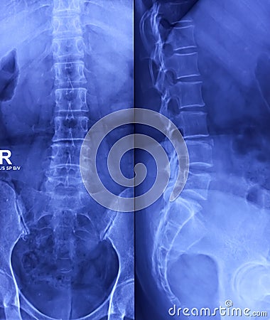 X-ray of Lumbosacral spine AP and Lateral view. Early degenerative change at lumbar spine. Limbus vertebra Stock Photo