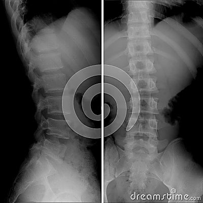 X-ray of Lumbosacral spine, Frontal Sagital view scoliosis Stock Photo