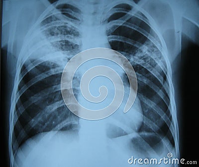 X-ray/lung Stock Photo