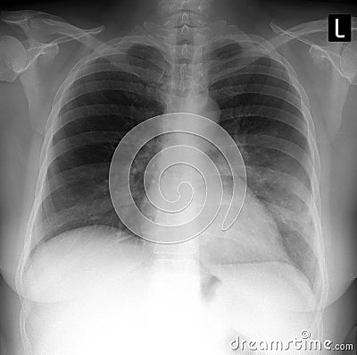 X-ray lung. showing a large infiltrate in the left lung. Pneumonia. Stock Photo