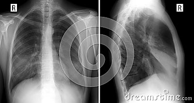 X-ray lung. showing a large infiltrate in the middle lobe of the right lung. Pneumonia. front and lateral projection Stock Photo