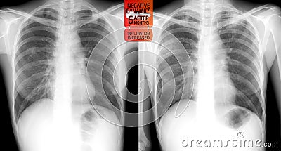 X-ray of the lungs: Escalation tuberculosis of the lungs after 6 months. Stock Photo