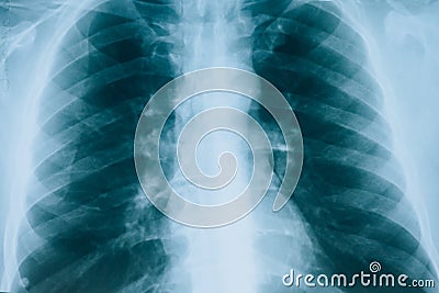 X-ray of lungs, fluorography. Medical scan of the lungs Stock Photo