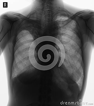 X-ray of the lungs: Postradiation pneumofibrosis. Negative. Stock Photo