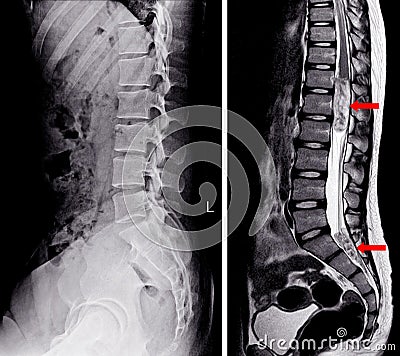 X-ray and MRI Lumbar spine Stock Photo