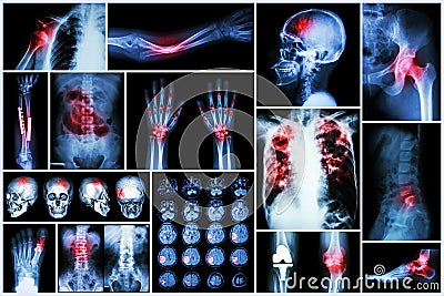 X-ray multiple disease (Stroke (cerebrovascular accident) : cva ,Pulmonary tuberculosis ,Bone fracture ,Shoulder dislocation Stock Photo