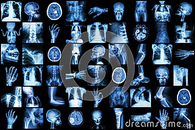 X-ray multiple part of adult and child and Disease ( Pulmonary tuberculosis Stroke kidney stone osteoarthritis bone fracture bowel Stock Photo