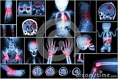 X-ray multiple part of child's body & multiple disease ( stroke , brain tumor , rheumatoid arthritis , sinusitis , gouty arthriti Stock Photo
